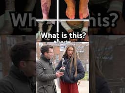 Doctor explains Epidermolysis Bullosa #shorts
