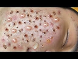 Loan Nguyen Acne Treatment 74x