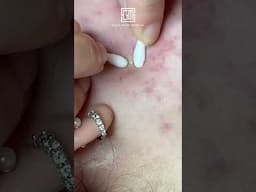 Watch to see her results🤩!! Tired of stubborn acne? Try the Aladdin Acne Care Treatment!✨