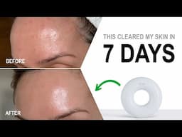 How I Cleared My Skin in 7 Days!
