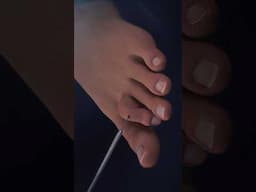 What is hammertoe Surgery? Surgical procedure to straighten toes #medical3danimation