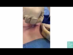 Short Scar Breast Augmentation