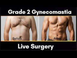 Gynecomastia In Bhopal |  Gynecomastia In Gwalior | Gynecomastia In Jabalpur