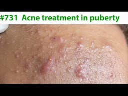 Acne Treatment Huong Da Nang#731  Acne treatment in puberty