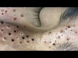 Loan Nguyen Acne Treatment 67x