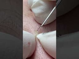 AcneTreatment Mai Ngoc Da Nang #acnetreatments #pimple #điềutrịmụnđànẵng #blackheads #acne