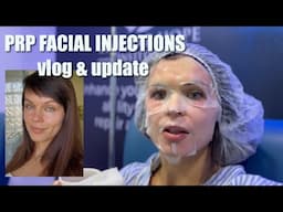 I Tried PRP Facial Injections & Stem Cell Treatment | 3-Month Results & Before & After Review