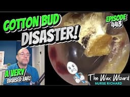 COTTON BUD DISASTER! Episode 443 (a very bruised canal!)