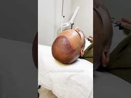 FUE Hair Transplant Turkey - 10th Month Update @cabhealth #hairtransplant #hairtransplantturkey