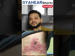 हर्पिज् कैसे ठीक होता है 🔥 Herpes Treatment Sorts #skincaretips #gyanear