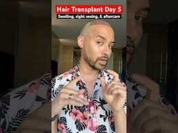 Hair Transplant Update: Day 5