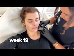 vlog: getting my lips dissolved + back in routine at home!!