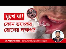মুখে ঘা হলে কি করণীয়? মুখের ঘা কোন রোগের লক্ষণ? What Causes Mouth Ulcers? Symptoms of Mouth Cancer