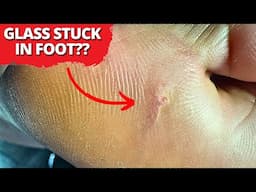 Glass Stuck Deep in Foot For Months — Watch the Satisfying Removal!