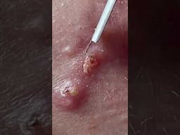 Acne Treatment Mai Ngọc #acne #acnetreatments #satisfying #điềutrịmụnđànẵng #blackheads #điềutrịmụn