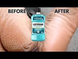 TRY LISTERINE ON YOUR DRY CRACKED FEET AND SEE WHAT HAPPENS  *SHOCKING RESULTS*