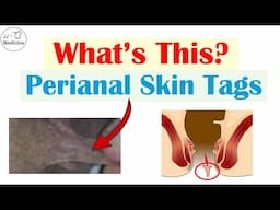 Perianal Skin Tags: Important Conditions That Cause Them