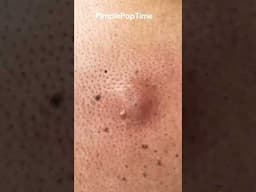 1 Minute Of Top ASMR Pimple Popping Video №107