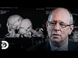 🧠 Gemelos atrapados: cuando nacer acompañado se convierte en una pesadilla 😱 | Mi Cuerpo, Mi Desafío