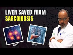 52-year-old with sarcoidosis removed from liver transplant list after rapid health reversal