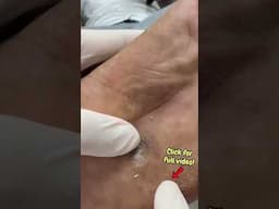 Stepped on Glass… Now This Corn Has to Come Out!