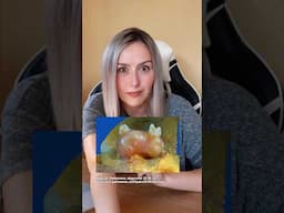 WTF, in Tumoren können Zähne wachsen?! 🦷🤢 #teratom