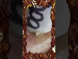 Blackheads Removal | Acne Treatment and Very Satisfying Satisfying Pimple pop #blackheads