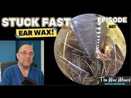 STUCK FAST EAR WAX! Episode 461 (as stuck as a sticky thing in a sticky situation!)