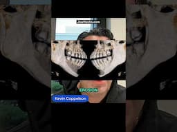 The problem with Silicone Implants and why PEEK might be a better option. #facialimplants #looksmax