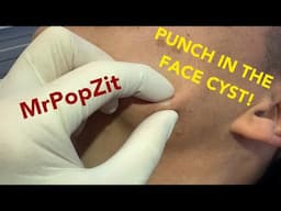 Many ask do I ever do punch removals?Well, here you go! A punch in the face to remove a growing ball