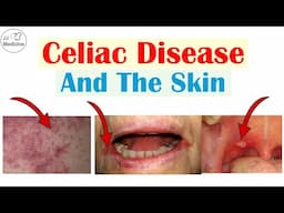 4 Skin Findings of Celiac Disease | Celiac Disease and the Skin