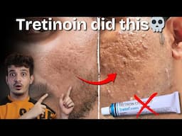 WARNING! Tretinoin Can DESTROY Your Face 😨