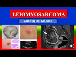 LEIOMYOSARCOMA - Definition, types, causes, pathophysiology, symptoms , diagnoses , medicine
