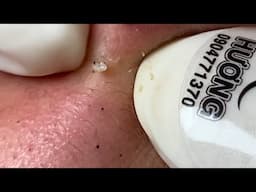 Acne Treatment Huong Da Nang# membership 008 |  | 2023