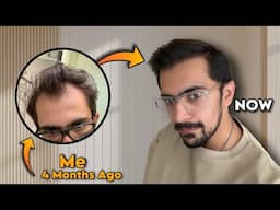 From BALD To Full Hair Growth - What I Did Before It Was Too Late.