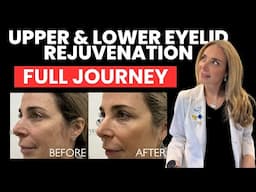 I Got an Eye Rejuvenation & Filmed EVERYTHING — You Won’t Believe the Results!