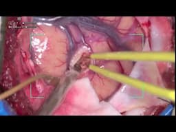 Connectomics-guided, augmented reality assisted resection of right frontal cavernous malformation..