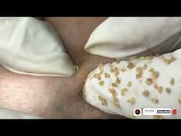Big Cystic Acne Blackheads Extraction Blackheads & Milia, Whiteheads Removal Pimple Popping
