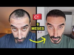 mi Transplante Capilar 6 meses después | toda la verdad y resultados reales