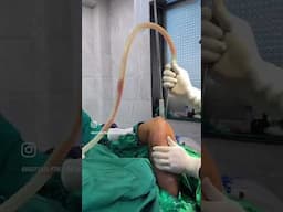 Arm Liposuction Surgery in Navi Mumbai | Sculpted Arms by Dr Arun Panda at Bodyskulpt Aesthetics 💪✨