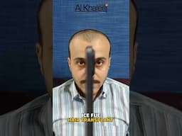 hair transplant cost in Karachi  #hairtransplantresults  #hairtransplantcost