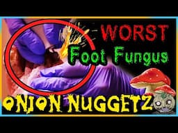 The Worst Case Of FOOT Fungus
