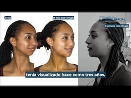 Cirugía monomaxilar Caso #162: Ma. Fernanda- Hipoplasia mandibular, Clase II, Mordida abierta