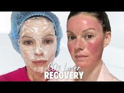 CO2 Fractional Laser Treatment in Thailand: Day by Day Recovery (Wks 1–3)