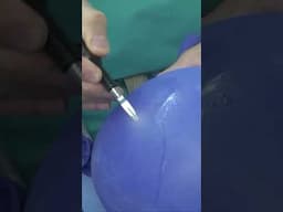 Revolutionizing Spine Surgery with Ultrasonic Technology | Dr. Jeffrey Cantor