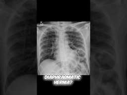What hernia goes away on its own?