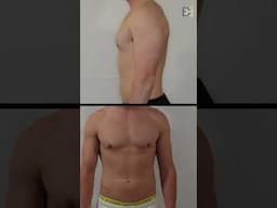 Moderate Gynaecomastia [BB grade 2a] {Patient 2022-7020} B&A 12 Months Post Surgery #shorts
