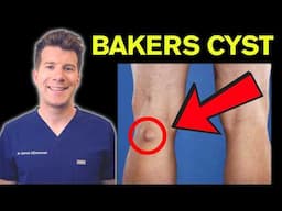 Doctor explains Bakers Cyst (Popliteal Cyst) | Causes, symptoms & treatment