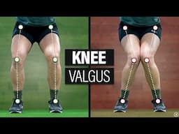 The Truth About Knee Valgus