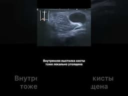 #узи #кистабейкера